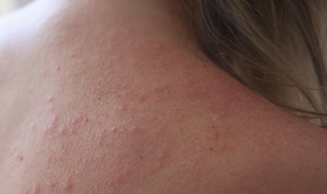 毛囊角化症是什麼? 要怎麼治療與保養呢?